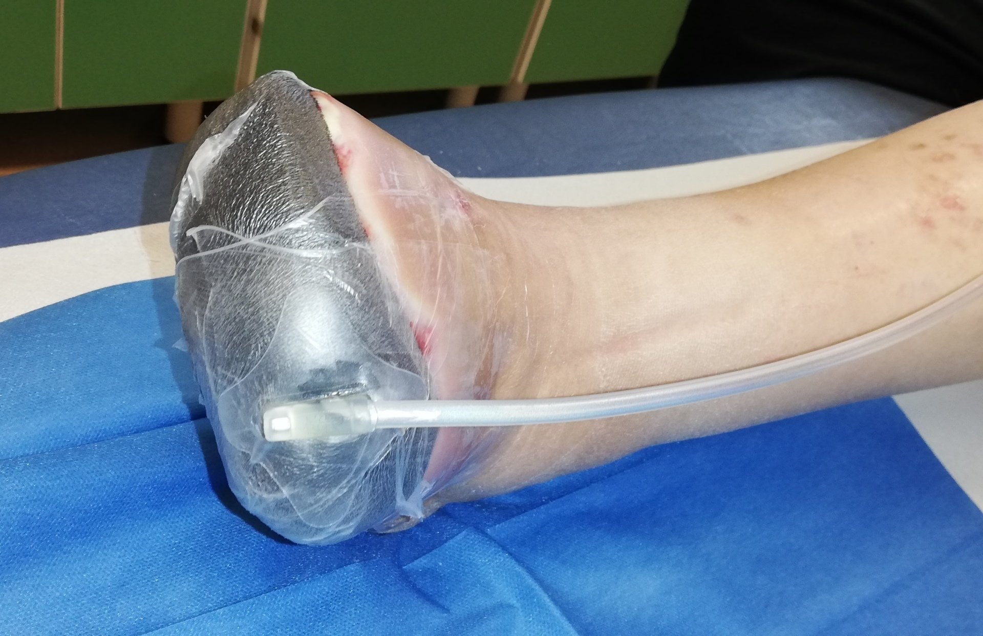 Medicazione Pressione Negativa Chirurgia Vascolare - Medicazione Pressione Negativa