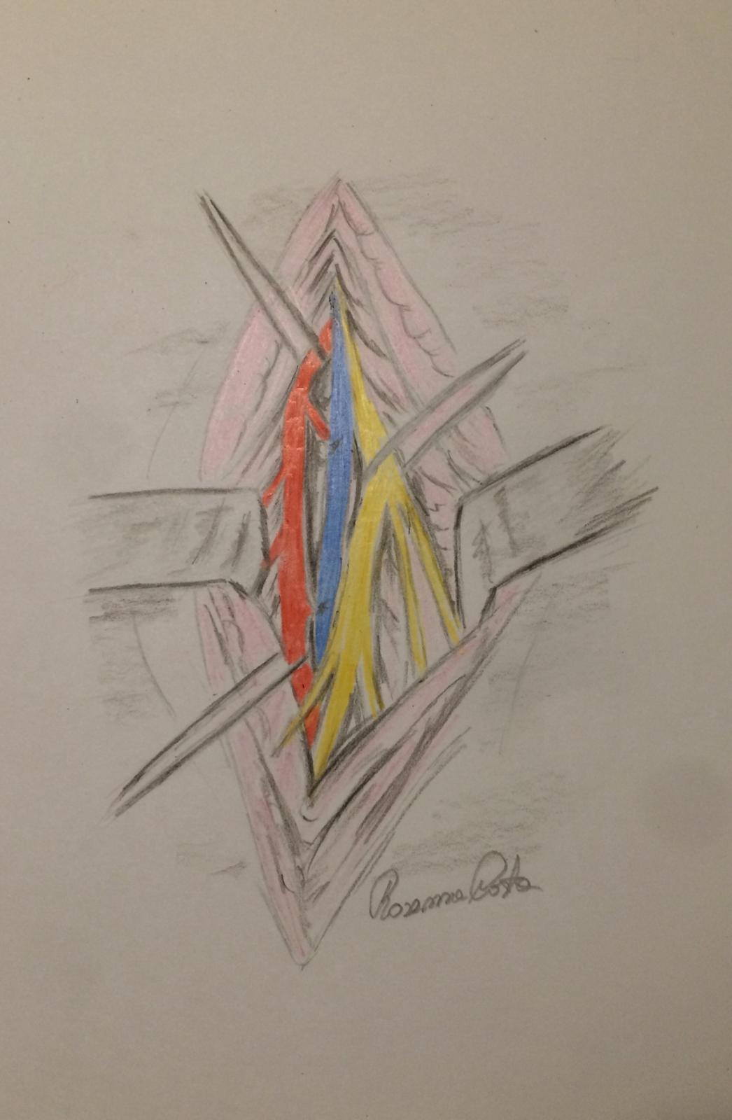 accesso chirurgico femorale Chirurgia Vascolare - accesso chirurgico femorale