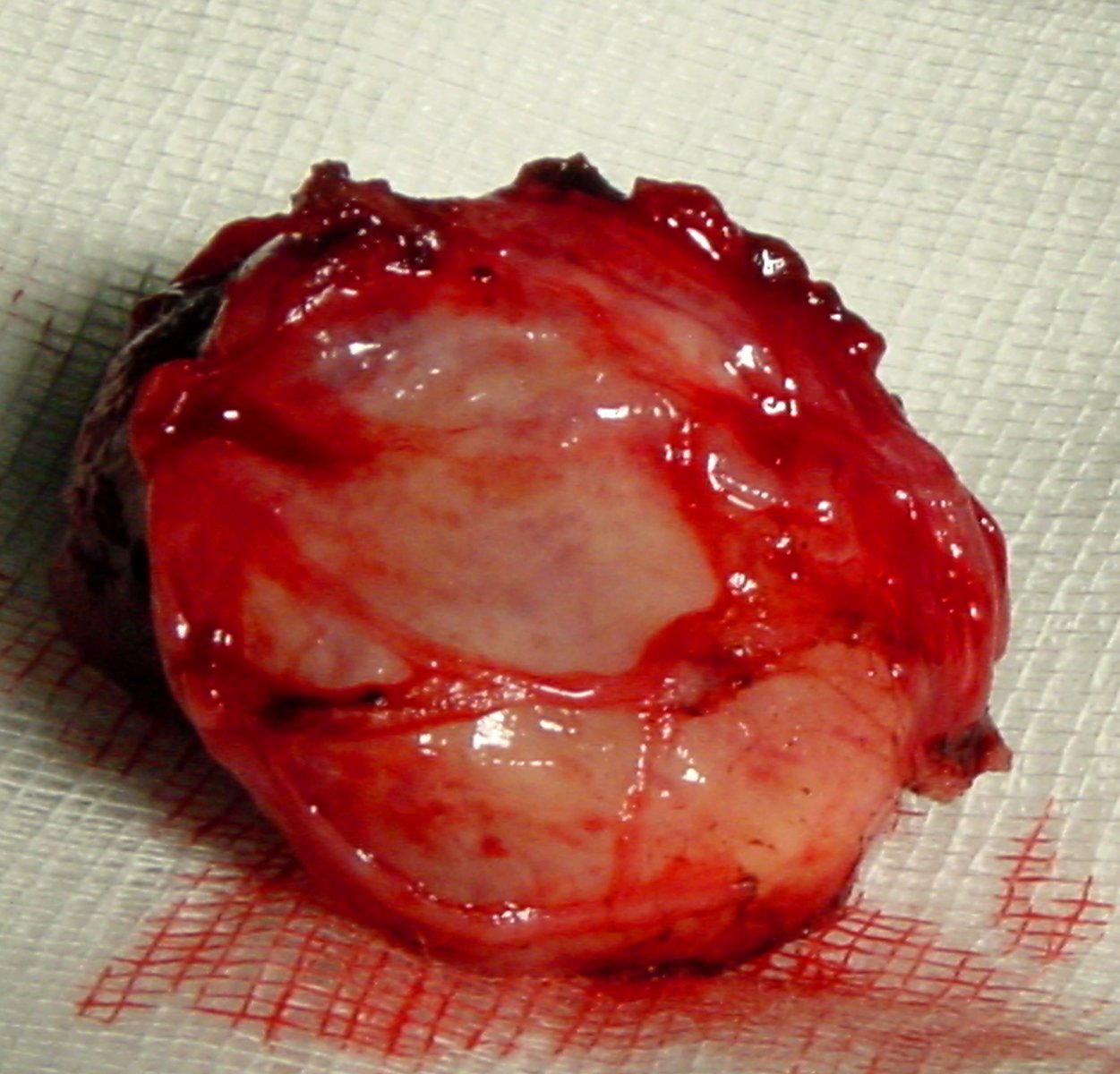 tumore del glomo carotideo