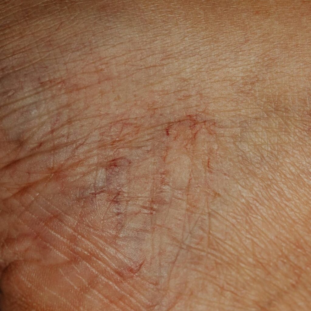 La scleroterapia è un trattamento ambulatoriale che prevede l’iniezione di una sostanza sclerosante nelle vene varicose o nei capillari, con lo scopo di farli chiudere progressivamente.