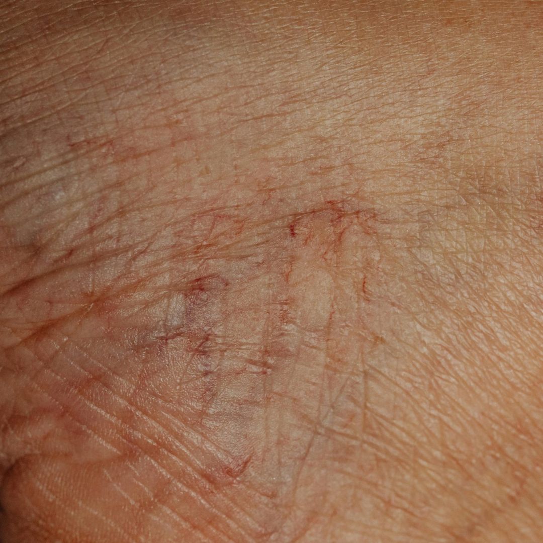 Copia di Medicina dello Sport (1080 x 1080 px) (4) Sclerosanti