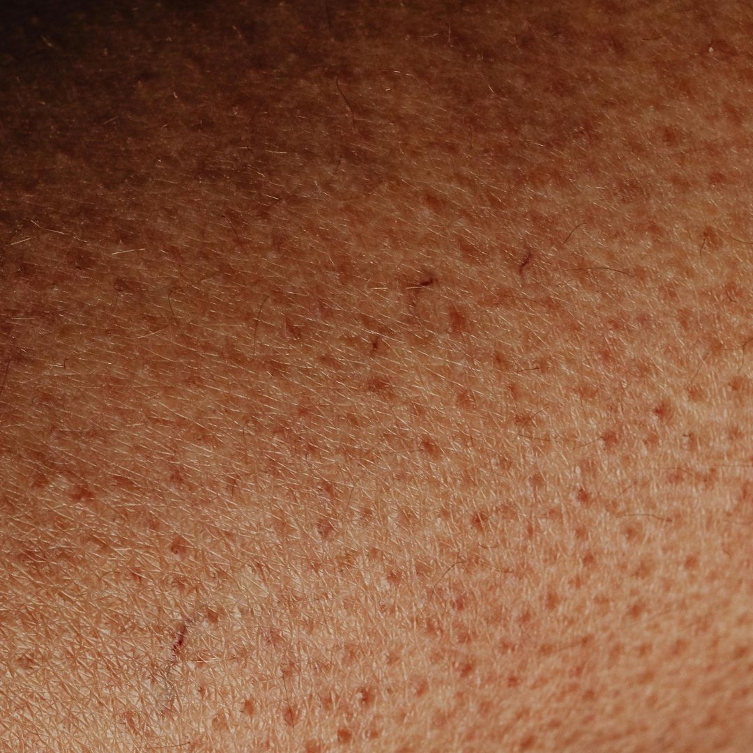 Copia di Medicina dello Sport (1080 x 1080 px) (6) La Visita Specialistica Dermatologica è l'esame fondamentale per la valutazione di qualsiasi disturbo cutaneo. Dermatoscopia in Epiluminescenza: Esame non invasivo per l'analisi approfondita dei nei e delle lesioni pigmentate. Diagnosi Precisa: Valutazione e identificazione di dermatiti, psoriasi, allergie cutanee e altre patologie.